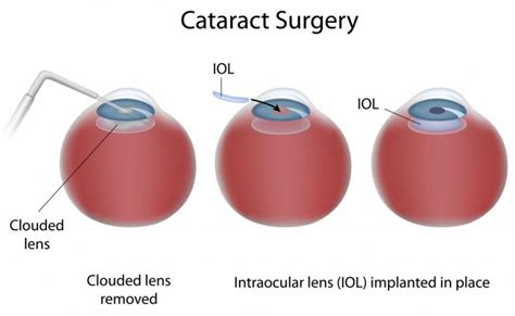 What types of cataract surgery are there?: Lowcountry Eye Specialists ...