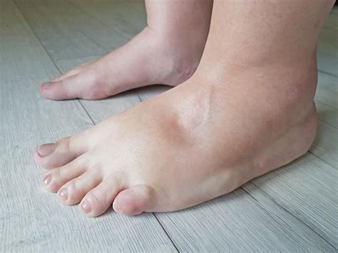 Foot Edema