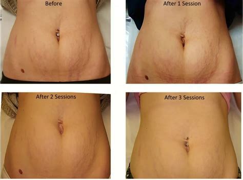 Laser Stretch Mark Removal: Doctor’s Review, Before & After ...