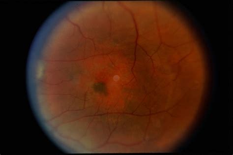 Choroidal Hemangioma - Retina Image Bank