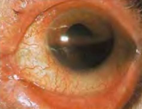 Medical Concept: Hyphema - CanadiEM