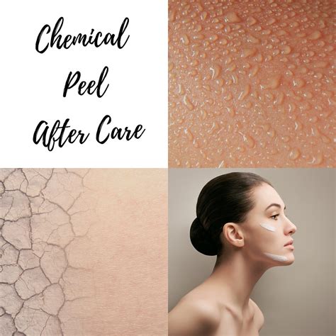 Let's Talk: Chemical Peel After Care