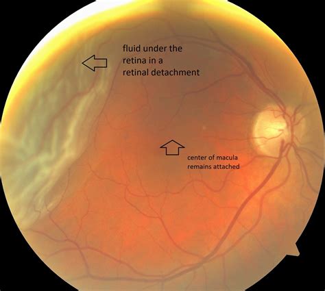 Choroidal Detachment Vs Retinal Detachment