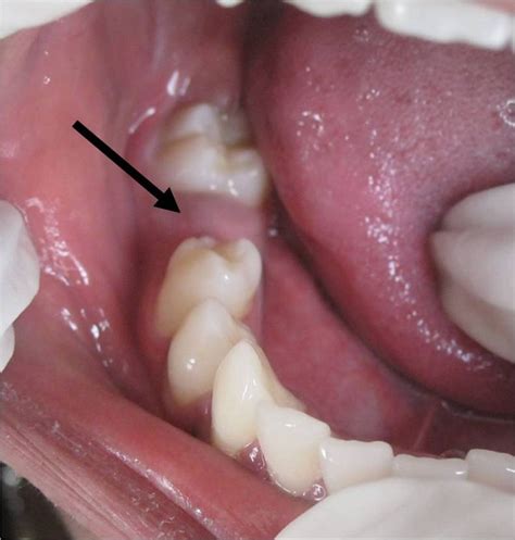 Wisdom Tooth Cyst On Gum