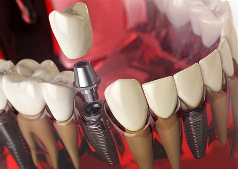 What you need to know about False Teeth in 2020 | Voss Dental - Oral ...