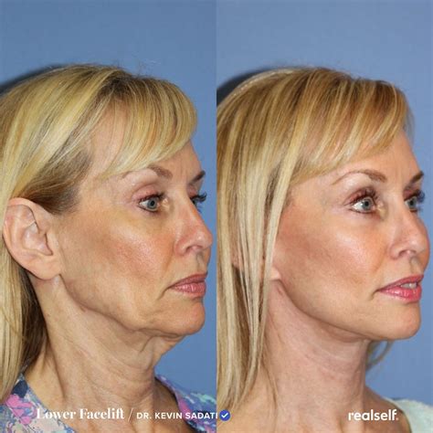 Lower Facelift: What to Expect, Results, Cost | RealSelf | Facelift ...