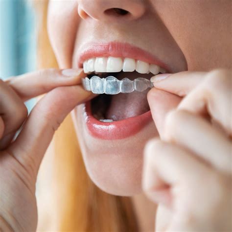 The Pros and Cons of At-Home Teeth Aligners, According to a Dentist ...