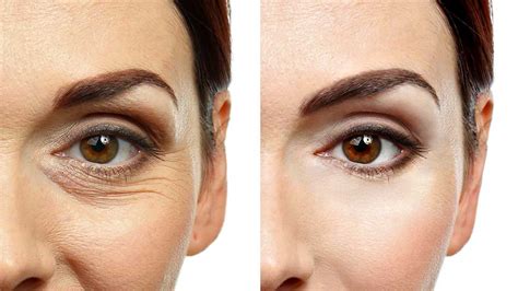 How to Tighten Skin Under Eyes Quickly [Full Guide] | Alma Lasers