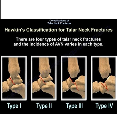 Complications of Talar Neck Fractures — OrthopaedicPrinciples.com