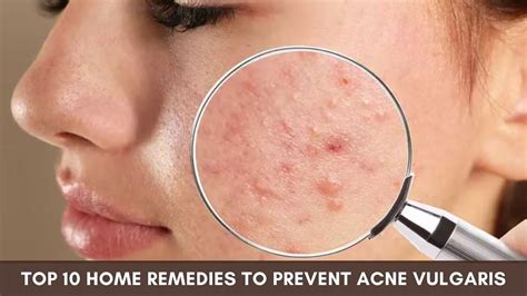 Top 10 Home Remedies to Prevent Acne Vulgaris