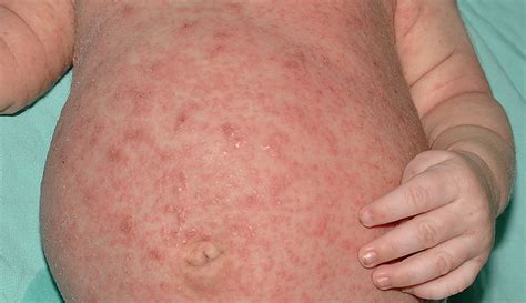 Scabies: Causes, Symptoms, Treatment & Prevention