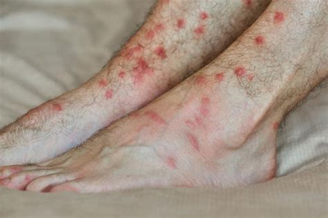 Gnat Bites : Prevention, Treatments - News Home