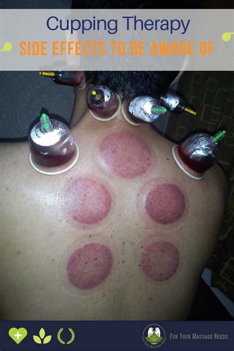 Cupping Therapy Side Effects (With images) | Cupping therapy, Cupping ...