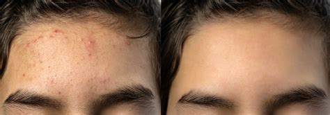 Pimples On Forehead - How to Have Clear, Bright Skin! - Healthwire