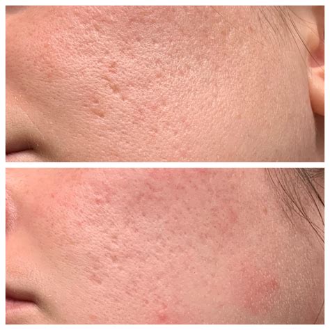 [B&A] 2 months progress on 0.025% tretinoin for acne scarring : r ...