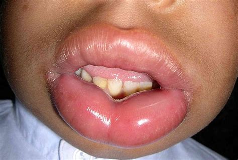 Swollen Lips And Hives Pictures | Lipstutorial.org