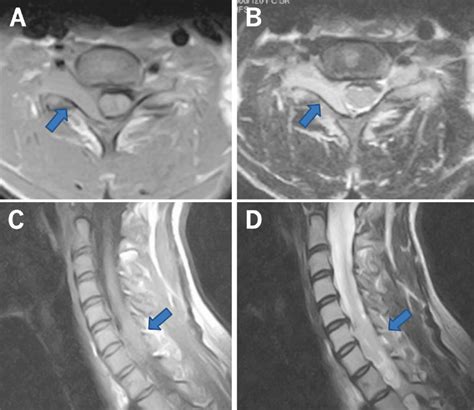 T1-and T2-weighted axial MRI of the cervical spine showed an Eden type ...