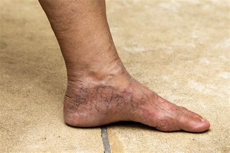 Understanding Varicose Veins in the Feet | Vein Institute Of Pinellas