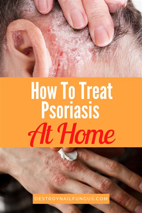 5 Amazing Home Remedies for Psoriasis That You Need To Try Now!