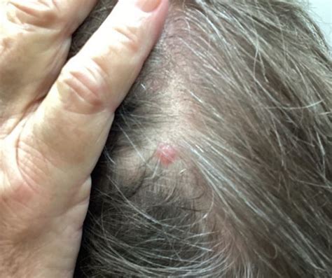 DermDx: Solitary Hairless Lesion on Scalp - Clinical Advisor