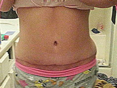 Tummy tuck surgery swelling after 4 weeks » Tummy Tuck: Prices, Photos ...