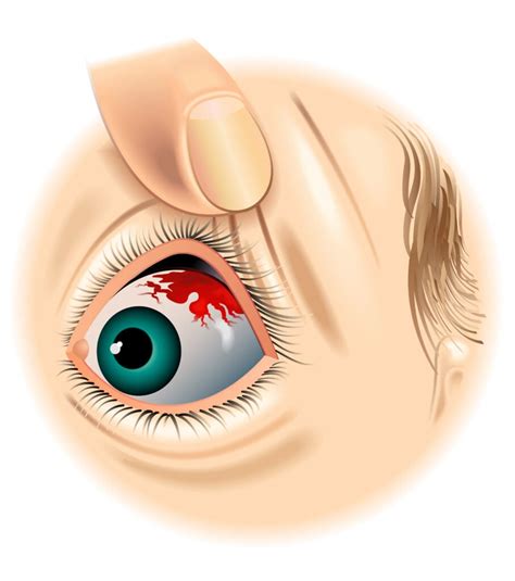 7 Causes of a Red Spot on Your Eye (And How to Treat Them)