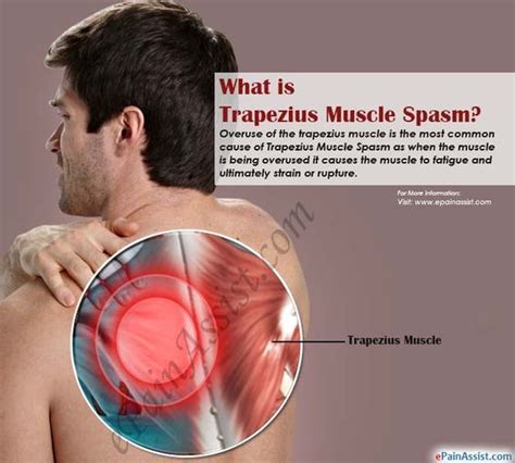 Trapezius Muscle Spasm Exercises