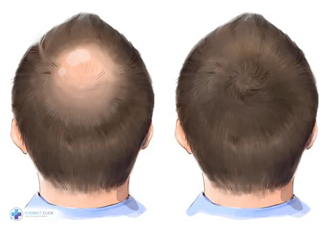 Finasteride Before After