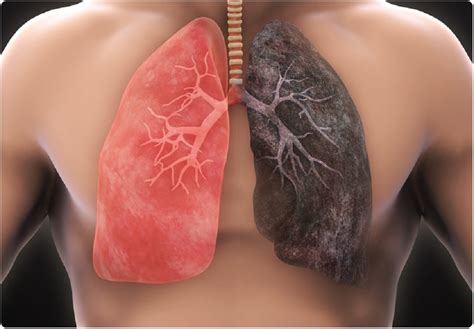 Chest X Ray Smoker Vs Nonsmoker