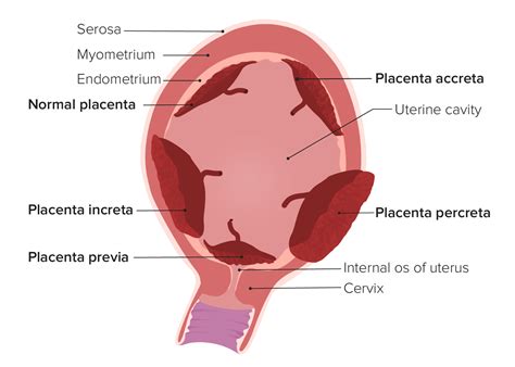 Abnormalities Of Placenta MEDizzy, 54% OFF | micoope.com.gt