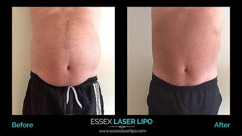 Laser Lipo Before And After | CHC Aesthetics | Essex Laser Lipo