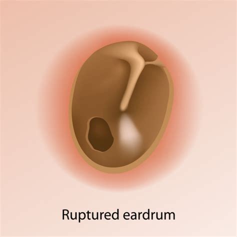 Perforated Tympanic Membrane Treatment