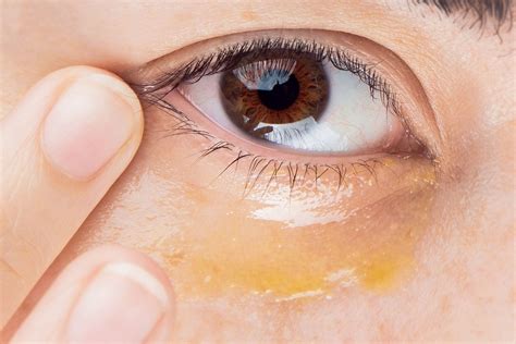 How To Quickly Treat Dry Under Eyes – 100% PURE