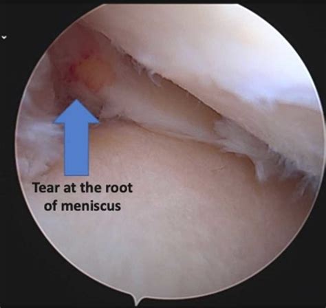 Torn Meniscus Swollen Knee