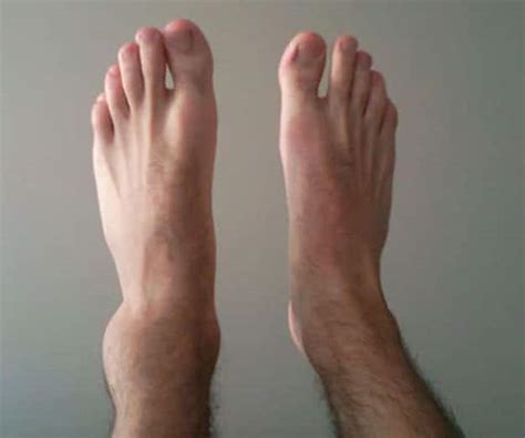 A Sprained Ankle - Causes, Symptoms, Types, Grades, Treatments