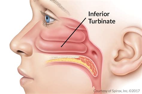 Nasal Turbinate Enlargement Las Vegas NV - Turbinate Reduction