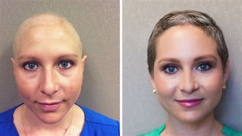 Chemo Hair Loss Eyebrows : Chemo Patient Says Eyebrow Gel Helped Her ...