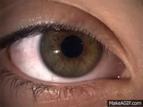 Hippus Pupil Reaction