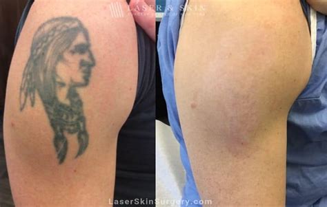 Share more than 54 skin removal tattoo - in.cdgdbentre