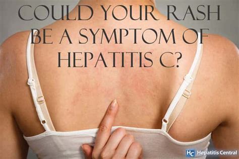 Hep C Symptoms - Could Your Rash Be One? | Hepatitis Central