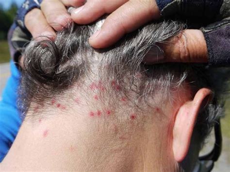 How To Tell If You Have Lice: Pay Attention To These 5 Signals!