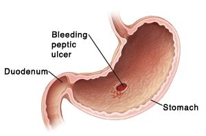 Best Otc Medicine For Stomach Ulcer - MedicineWalls