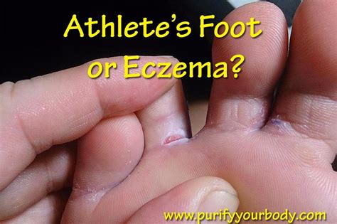 I thought I had athlete's foot - but it turned out to be eczema. Here ...