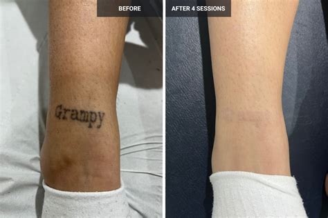 Laser Tattoo Removal - Before & After