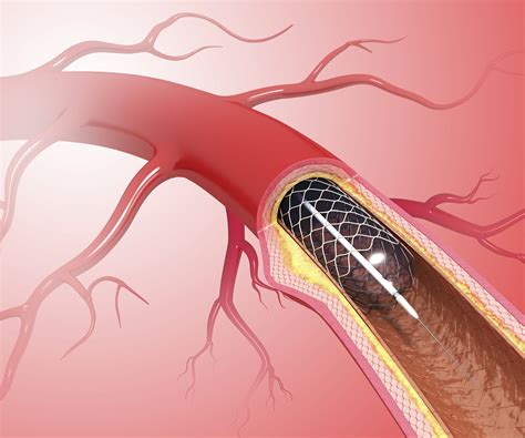 Anti-Platelet Drug Therapy After a Stent