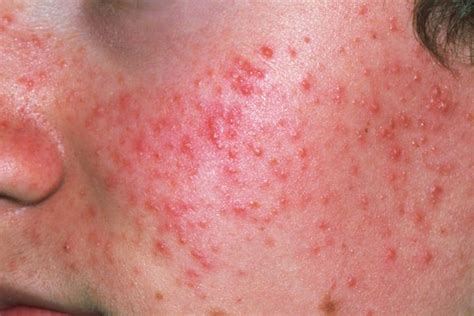 Red Bumps On Face