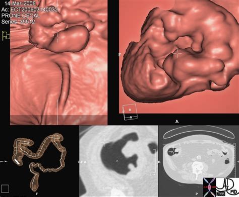 Ileocecal Valve | Colon