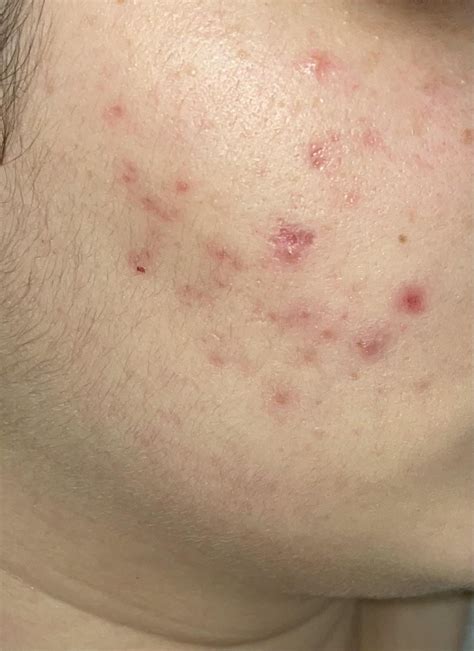 Cystic acne scars help : r/SkincareAddicts