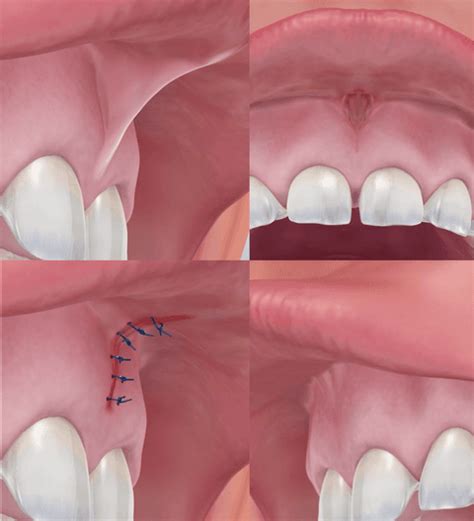 Frenulum Lip Lower