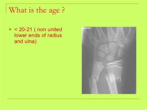 Bone age estimation